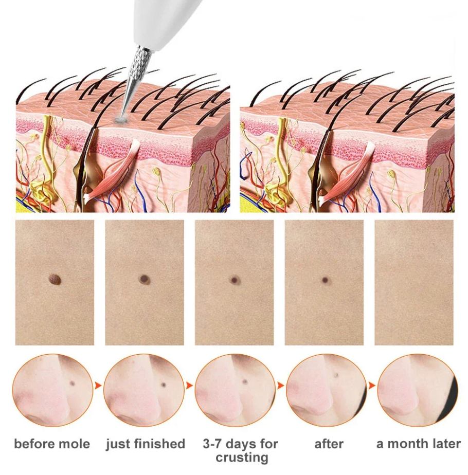 GlowErase™  Spot Removal Pen
